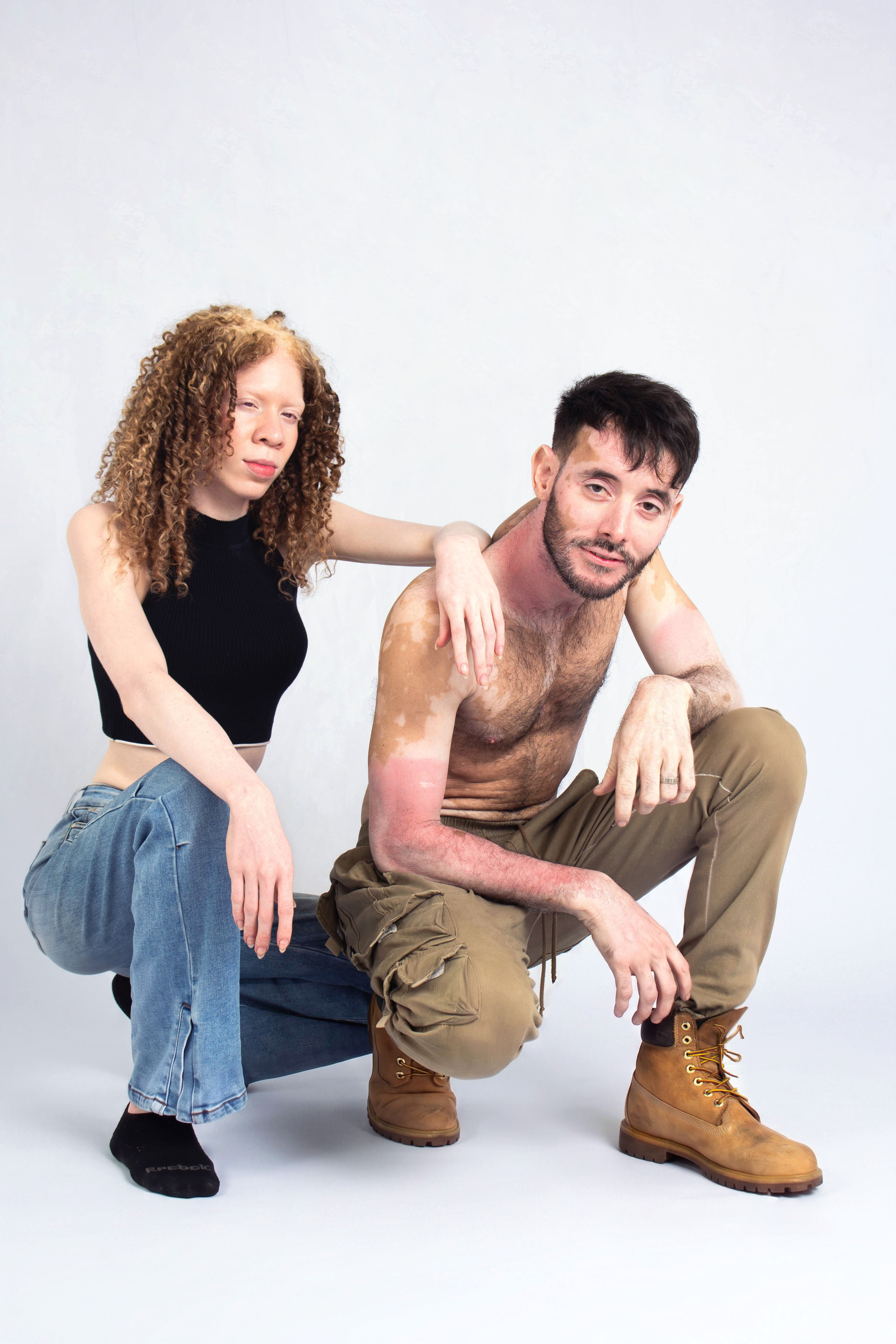 Modelaje Inclusivo Vitiligo Albinismo